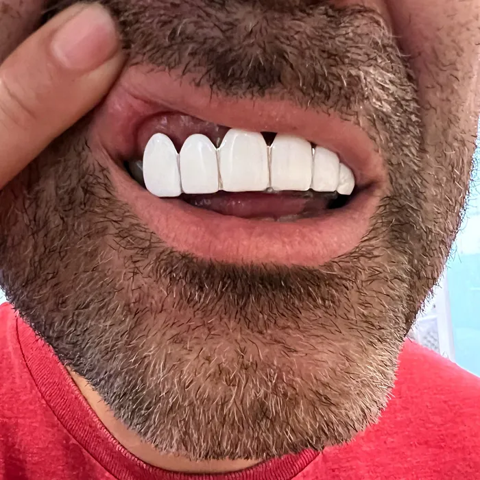 Rings Bling Cartel Real Solid 925 Sterling Silver White Enamel Top Six Teeth Grillz Rings Bling Cartel Real Solid 925 Sterling Silver White Enamel Top Six Teeth Grillz